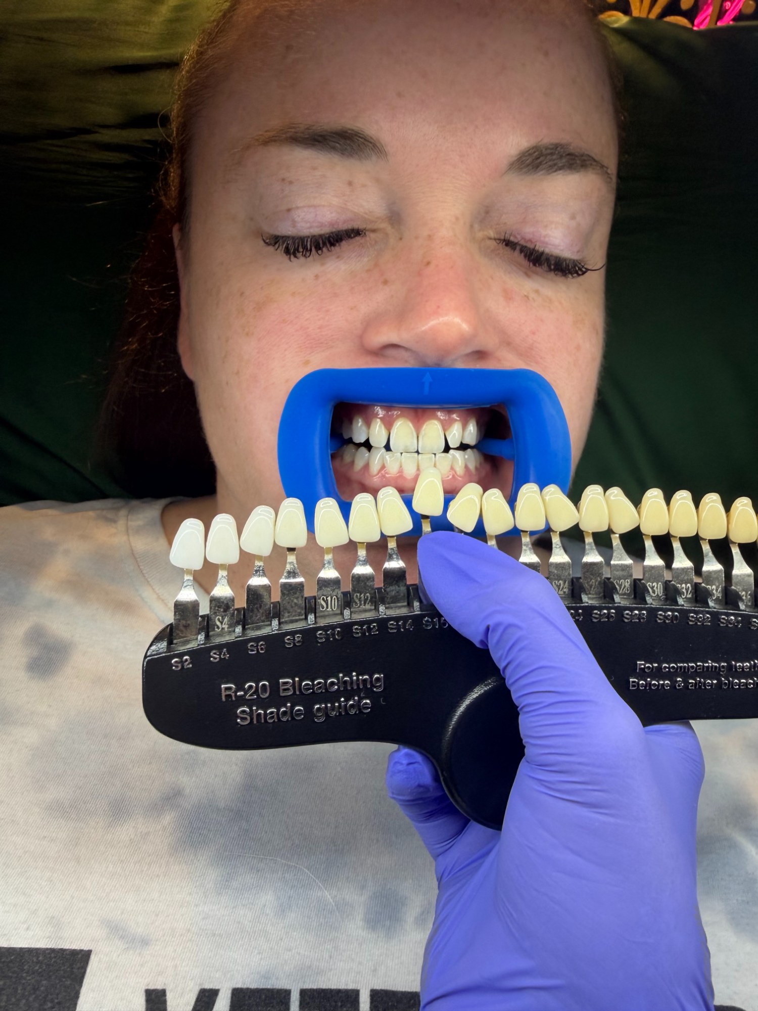 Professional teeth whitening — The Bronze Lily, St. Petersburg, FL