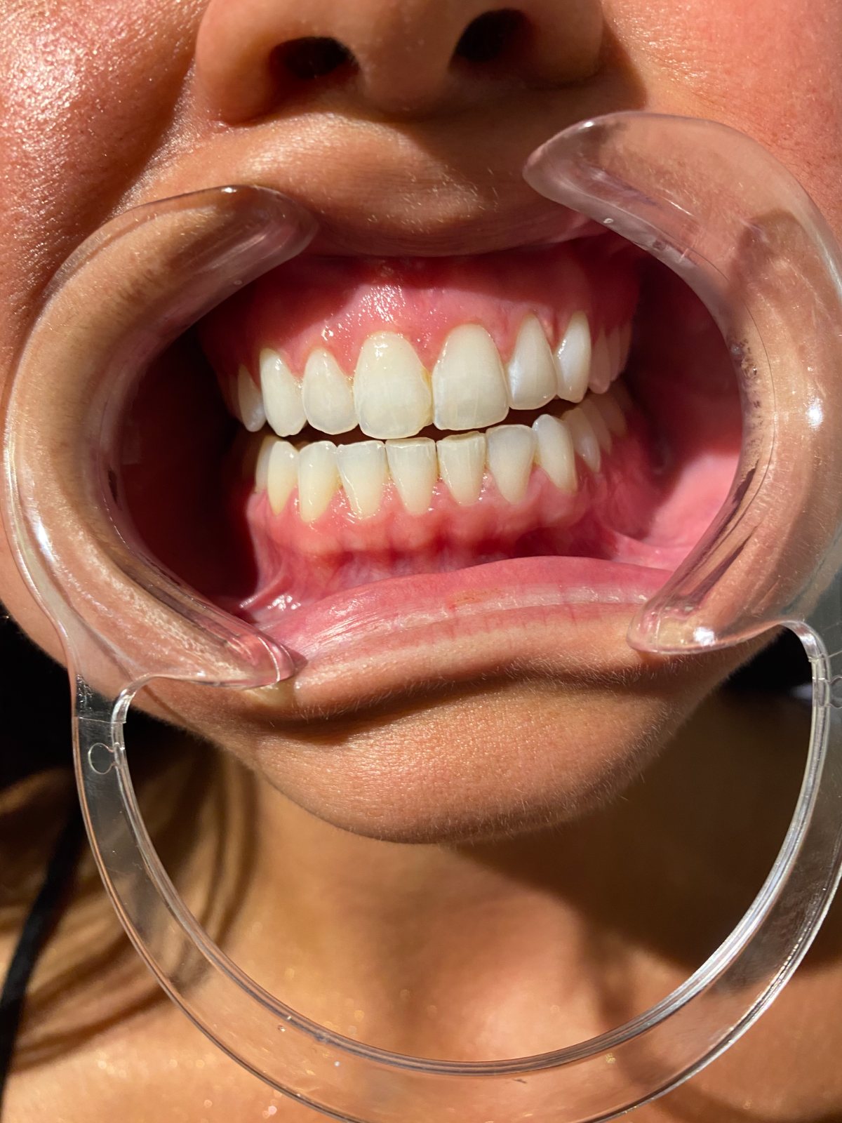 Teeth whitening before and after — The Bronze Lily, St. Petersburg, FL