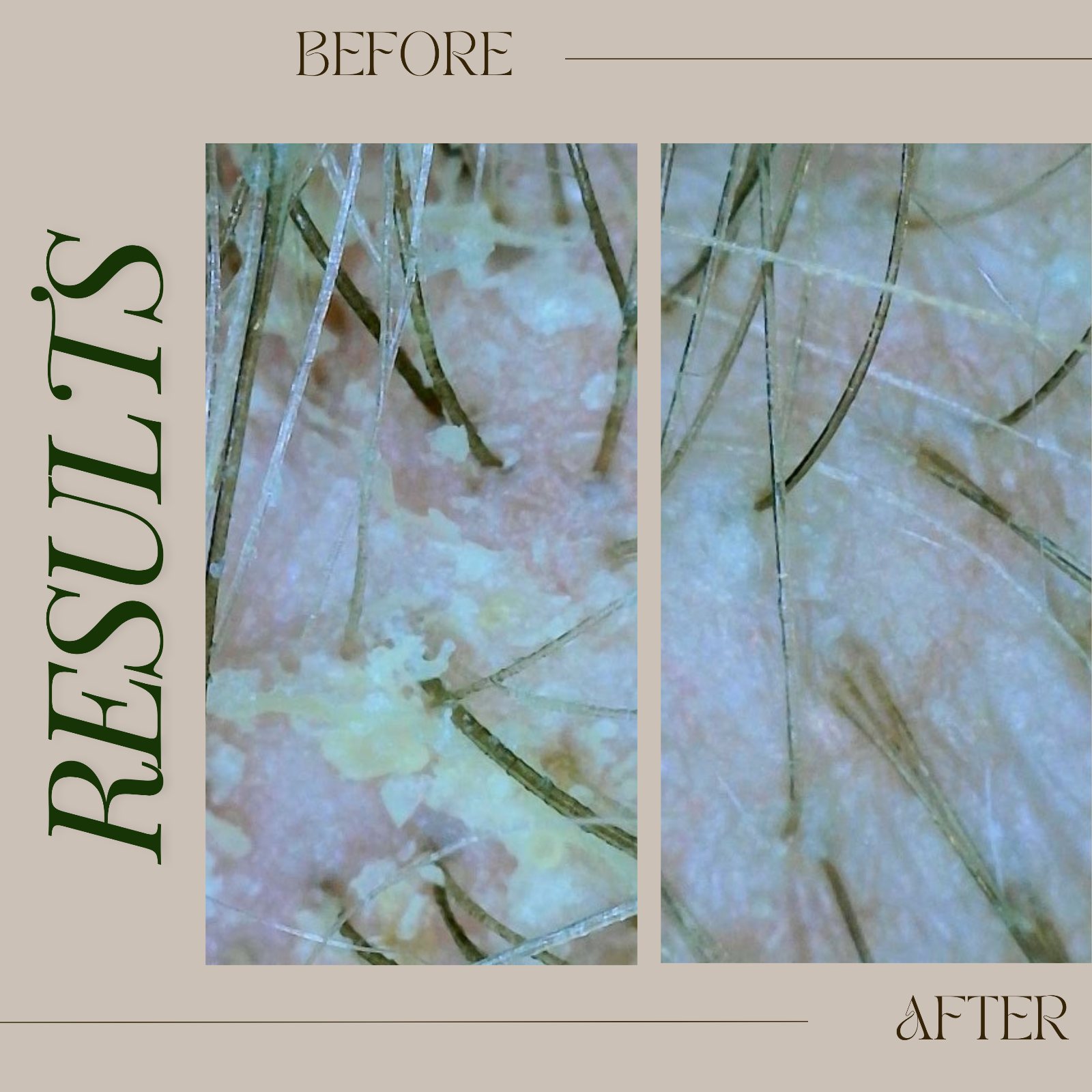 Tricho results, before & after composite 2 — The Bronze Lily, St. Petersburg, FL