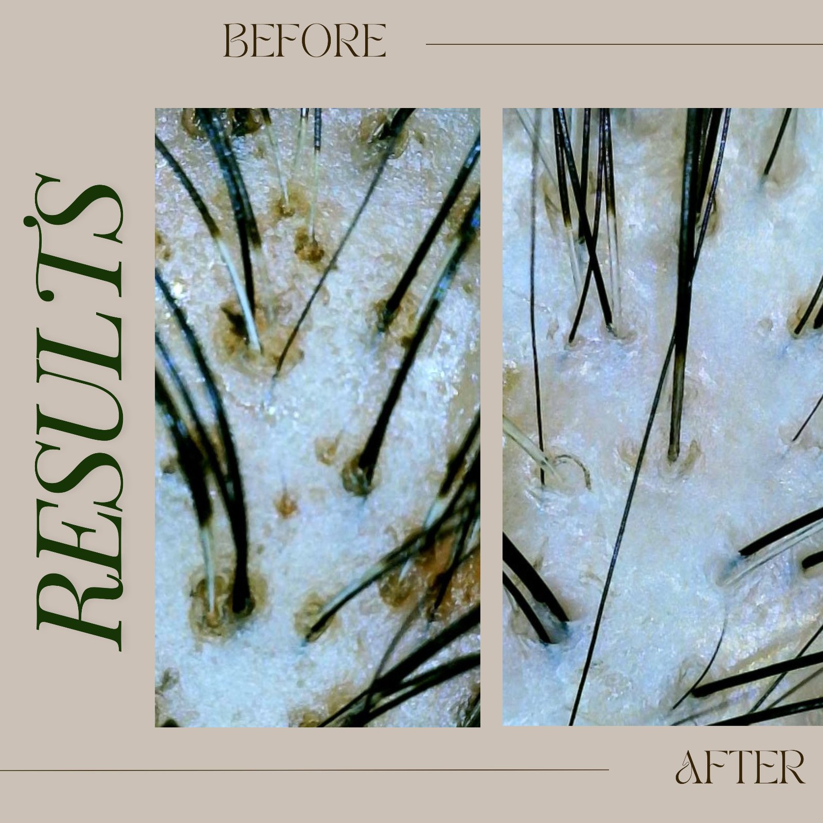 Tricho results, before & after composite 3 — The Bronze Lily, St. Petersburg, FL